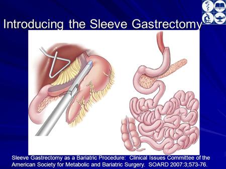 Introducing the Sleeve Gastrectomy Sleeve Gastrectomy as a Bariatric Procedure: Clinical Issues Committee of the American Society for Metabolic and Bariatric.