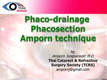 Phaco-drainage Phacosection Amporn technique
