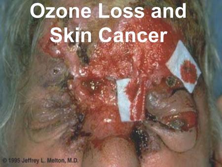 Ozone Loss and Skin Cancer. Problem 1986 - Susan Solomon found the correlation between the disappearance of ozone and increased concentration of chloroflurocarbons.