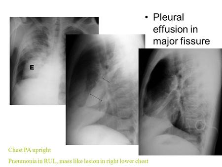 Pleural effusion in major fissure Chest PA upright Pneumonia in RUL, mass like lesion in right lower chest.