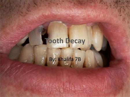Tooth Decay By: Khalifa 7B.
