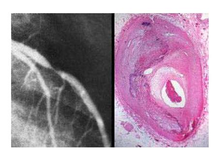 The left frame shows marked narrowing as seen by angiography. The right frame shows the histology of the narrowed area. There is marked thickening of.