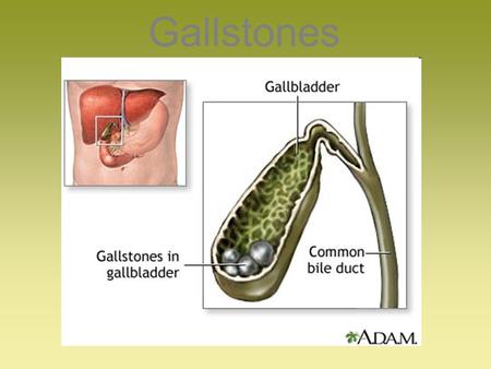 Gallstones.