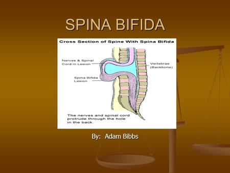 SPINA BIFIDA By: Adam Bibbs. Outline for Presentation Life story of Jimmy Life story of Jimmy What is Spina Bifida? What is Spina Bifida? Signs and Symptoms.