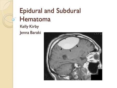 Epidural and Subdural Hematoma