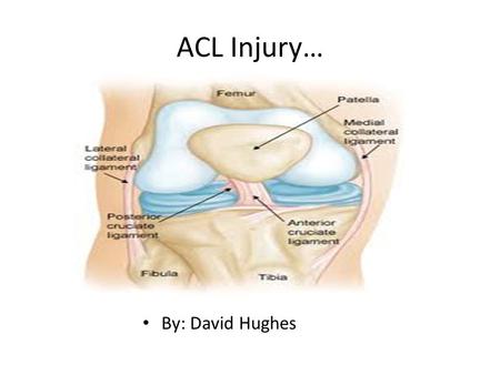 ACL Injury… By: David Hughes. Symptoms… There are only a few symptoms of an ACL injury, but they are very obvious symptoms. One symptom of an ACL injury.