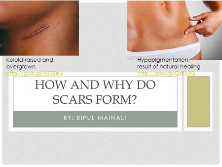 BY: BIPUL MAINALI HOW AND WHY DO SCARS FORM? Keloid-raised and overgrown  Hypopigmentation- result of natural healing