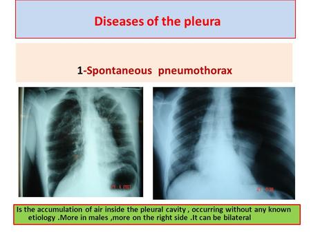 Diseases of the pleura 1-Spontaneous pneumothorax Is the accumulation of air inside the pleural cavity, occurring without any known etiology.More in males,more.