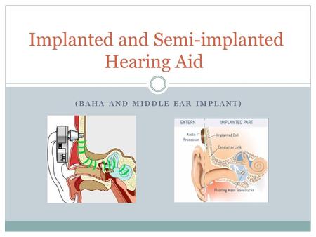 Implanted and Semi-implanted Hearing Aid
