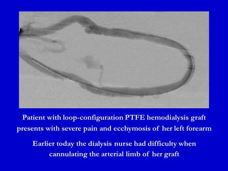 Patient with loop-configuration PTFE hemodialysis graft presents with severe pain and ecchymosis of her left forearm Earlier today the dialysis nurse had.