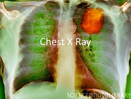 Chest X Ray. How Do They Work? They are a form of electromagnetic radiation. X-rays have high energy and short wavelength and are able to pass through.
