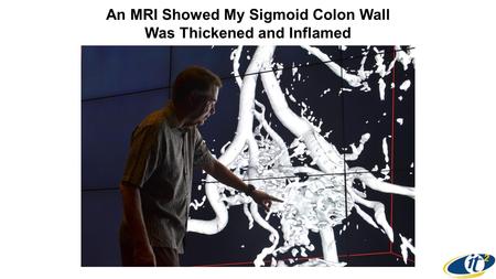 An MRI Showed My Sigmoid Colon Wall Was Thickened and Inflamed.