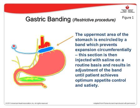 Bariatric Surgical Procedures Adapted from Poirier et al. Bariatric surgery and cardiovascular risk factors: a scientific statement from the American Heart.