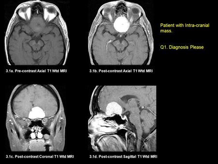 Patient with Intra-cranial mass.