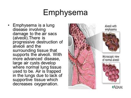 Emphysema Emphysema is a lung disease involving damage to the air sacs (alveoli).There is progressive destruction of alveoli and the surrounding tissue.