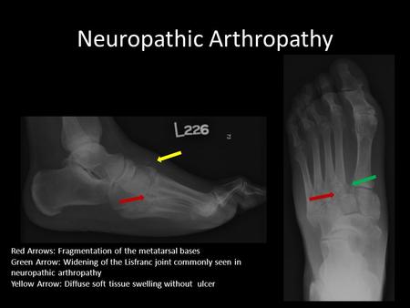 Neuropathic Arthropathy Red Arrows: Fragmentation of the metatarsal bases Green Arrow: Widening of the Lisfranc joint commonly seen in neuropathic arthropathy.