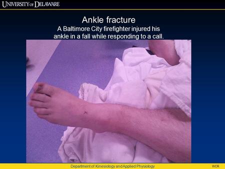 Department of Kinesiology and Applied Physiology WCR Ankle fracture A Baltimore City firefighter injured his ankle in a fall while responding to a call.