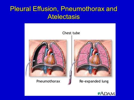 Pleural Effusion, Pneumothorax and Atelectasis