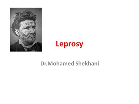 Leprosy Dr.Mohamed Shekhani. Who is at risk?   web/pages/leprosy/images/girl.