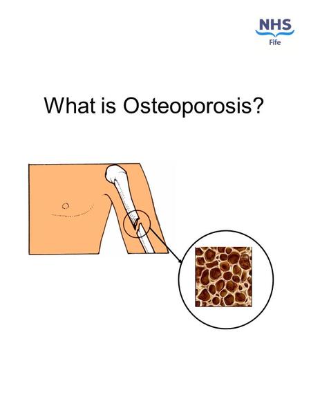 What is Osteoporosis?. What is osteoporosis? Osteoporosis is an illness that can happen in your bones when you get older. Osteoporosis happens to more.