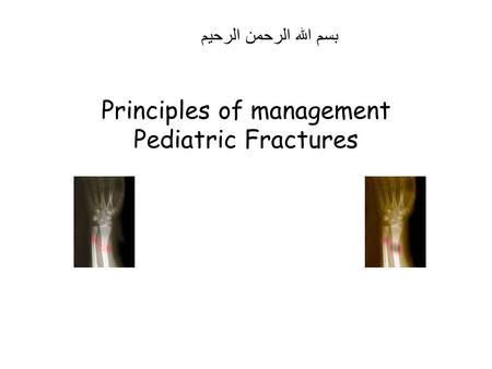 Principles of management Pediatric Fractures
