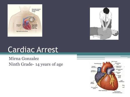 Cardiac Arrest Mirna Gonzalez Ninth Grade- 14 years of age.