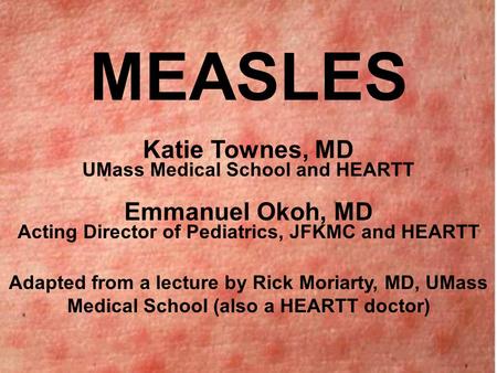 MEASLES Katie Townes, MD UMass Medical School and HEARTT Emmanuel Okoh, MD Acting Director of Pediatrics, JFKMC and HEARTT Adapted from a lecture by Rick.