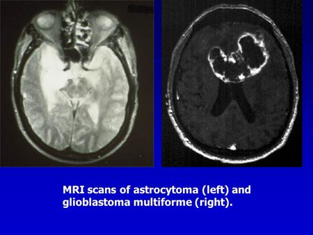 MRI scans of astrocytoma (left) and glioblastoma multiforme (right).