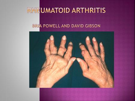  Inflammatory arthritis and an autoimmune disease  Immune system attacks the body’s own tissues  Fluid builds up in the joints, causing pain that’s.