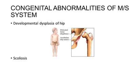 CONGENITAL ABNORMALITIES OF M/S SYSTEM Developmental dysplasia of hip Scoliosis.