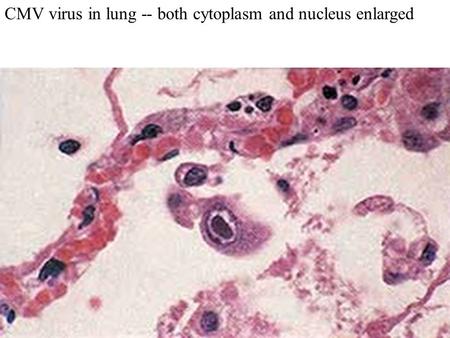 CMV virus in lung -- both cytoplasm and nucleus enlarged.