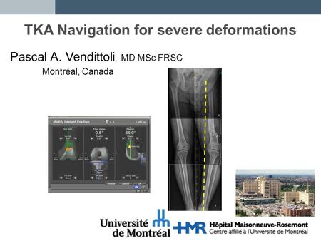 TKA Navigation for severe deformations Pascal A. Vendittoli, MD MSc FRSC Montréal, Canada.