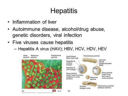 Hepatitis Inflammation of liver Autoimmune disease, alcohol/drug abuse, genetic disorders, viral infection Five viruses cause hepatitis –Hepatitis A virus.