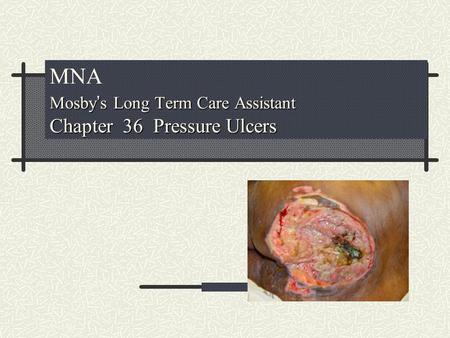 MNA Mosby’s Long Term Care Assistant Chapter 36 Pressure Ulcers