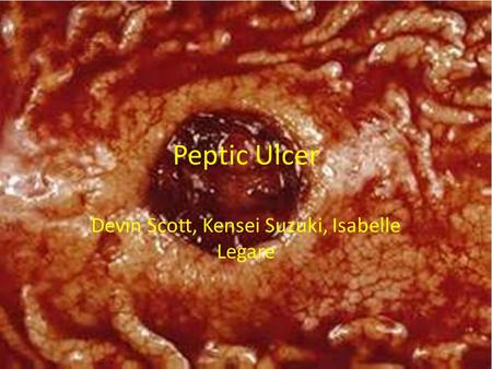 Peptic Ulcer Devin Scott, Kensei Suzuki, Isabelle Legare.