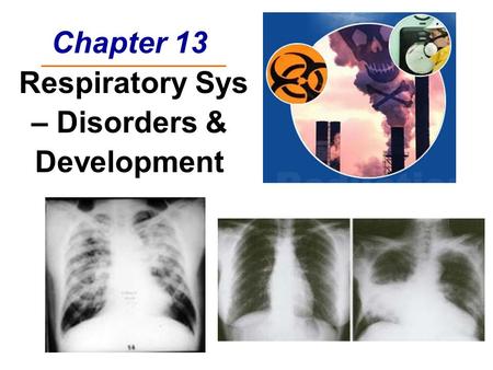 Chapter 13 Respiratory Sys – Disorders & Development.