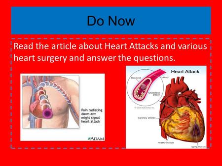 Do Now Read the article about Heart Attacks and various heart surgery and answer the questions.