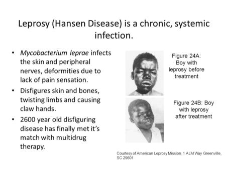 Leprosy (Hansen Disease) is a chronic, systemic infection.