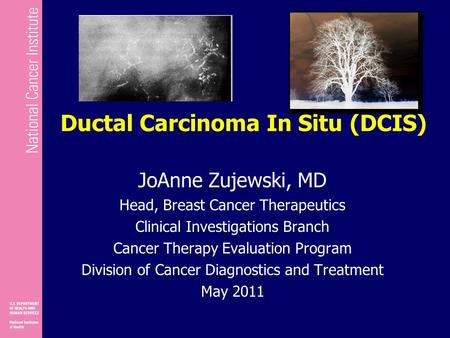 Ductal Carcinoma In Situ (DCIS)