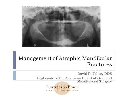 Management of Atrophic Mandibular Fractures David R. Telles, DDS Diplomate of the American Board of Oral and Maxillofacial Surgery.