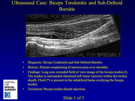 Ultrasound Case: Biceps Tendonitis and Sub-Deltoid Bursitis Diagnosis: Biceps Tendonitis and Sub-Deltoid Bursitis. History: Patient complaining of anterior.