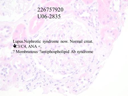 226757920 U06-2835 Lupus.Nephrotic syndrome now. Normal creat.  C3/C4, ANA +, ? Membranous ?antiphospholipid Ab syndrome.