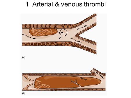 1. Arterial & venous thrombi. 2. Normal venous valve function.