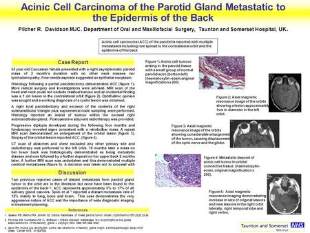 Acinic Cell Carcinoma of the Parotid Gland Metastatic to the Epidermis of the Back Pilcher R. Davidson MJC. Department of Oral and Maxillofacial Surgery,