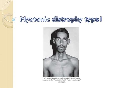 What is myotonic dystrophy? Myotonic dystrophy is part of a group of inherited disorders called muscular dystrophies. It is the most common form of muscular.