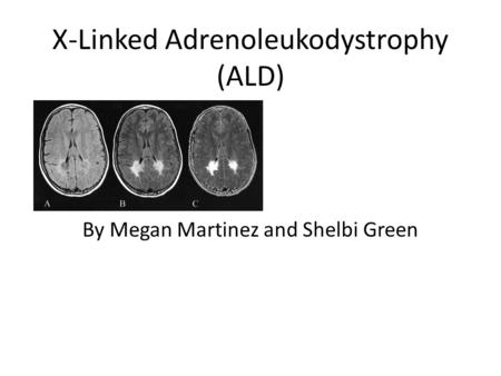 X-Linked Adrenoleukodystrophy (ALD)