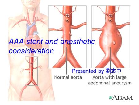 AAA stent and anesthetic consideration Presented by 劉志中.