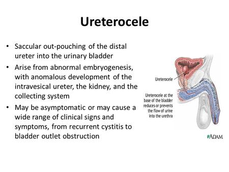 Ureterocele Saccular out-pouching of the distal ureter into the urinary bladder Arise from abnormal embryogenesis, with anomalous development of the intravesical.