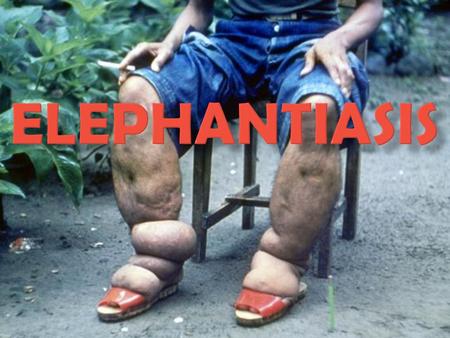  Elephantiasis is a disease that is characterized by the thickening of the skin and underlying tissues, especially in legs and male genitals.  In some.