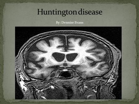 Huntington disease By: Dennise Evans.